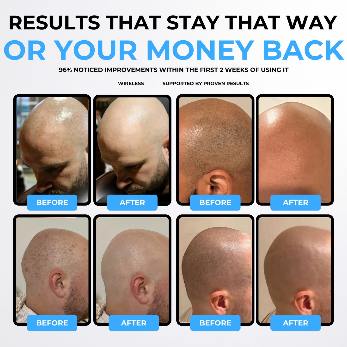 VapoShine Baldli™ Scalp IPL Laser Hair Remover