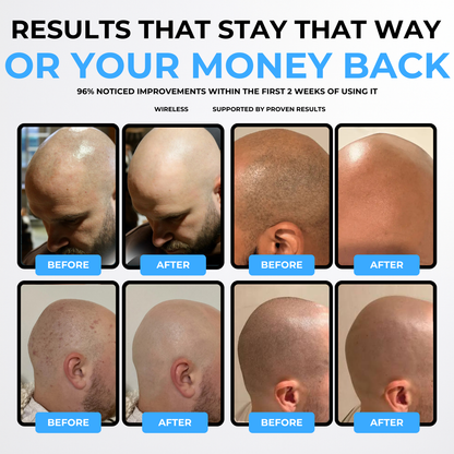 VapoShine Baldli™ Scalp IPL Laser Hair Remover